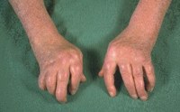 Rheumatoide Arthritis (cP)